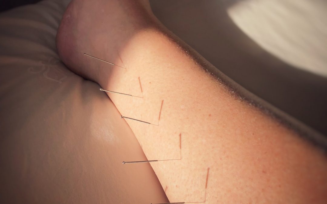 How Can Acupuncture Therapy Help to Reduce Anxiety Levels?